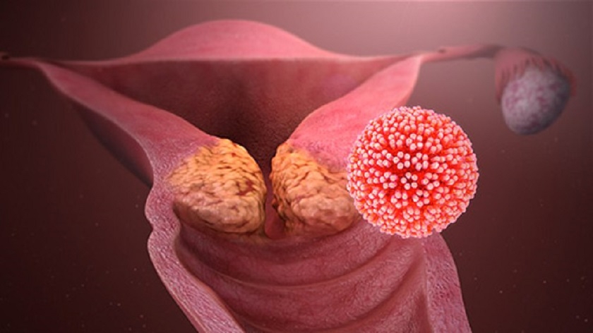 Santé : la Tunisie entame en 2025 la vaccination contre le HPV responsable du cancer du col de l’utérus